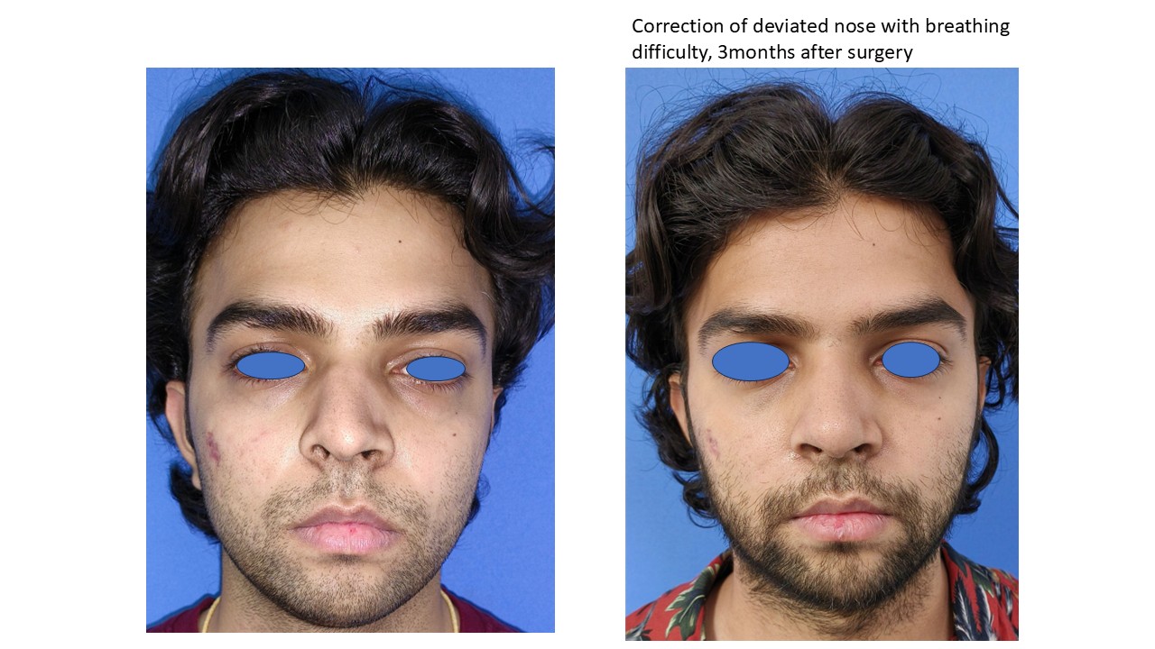 Rhinoplasty Photo 10